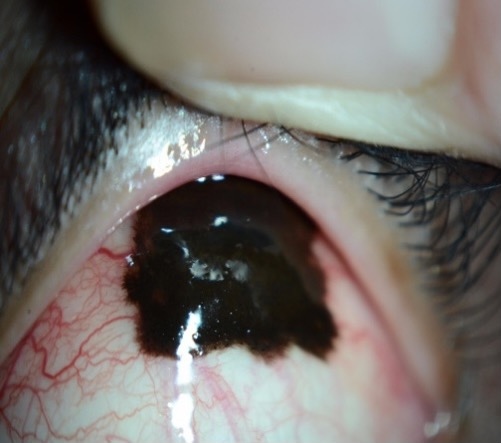melanoma