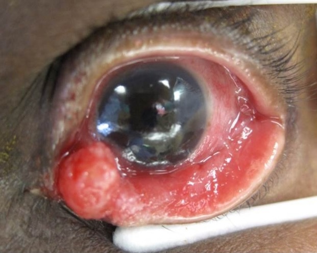 squamous cell carcinoma 2