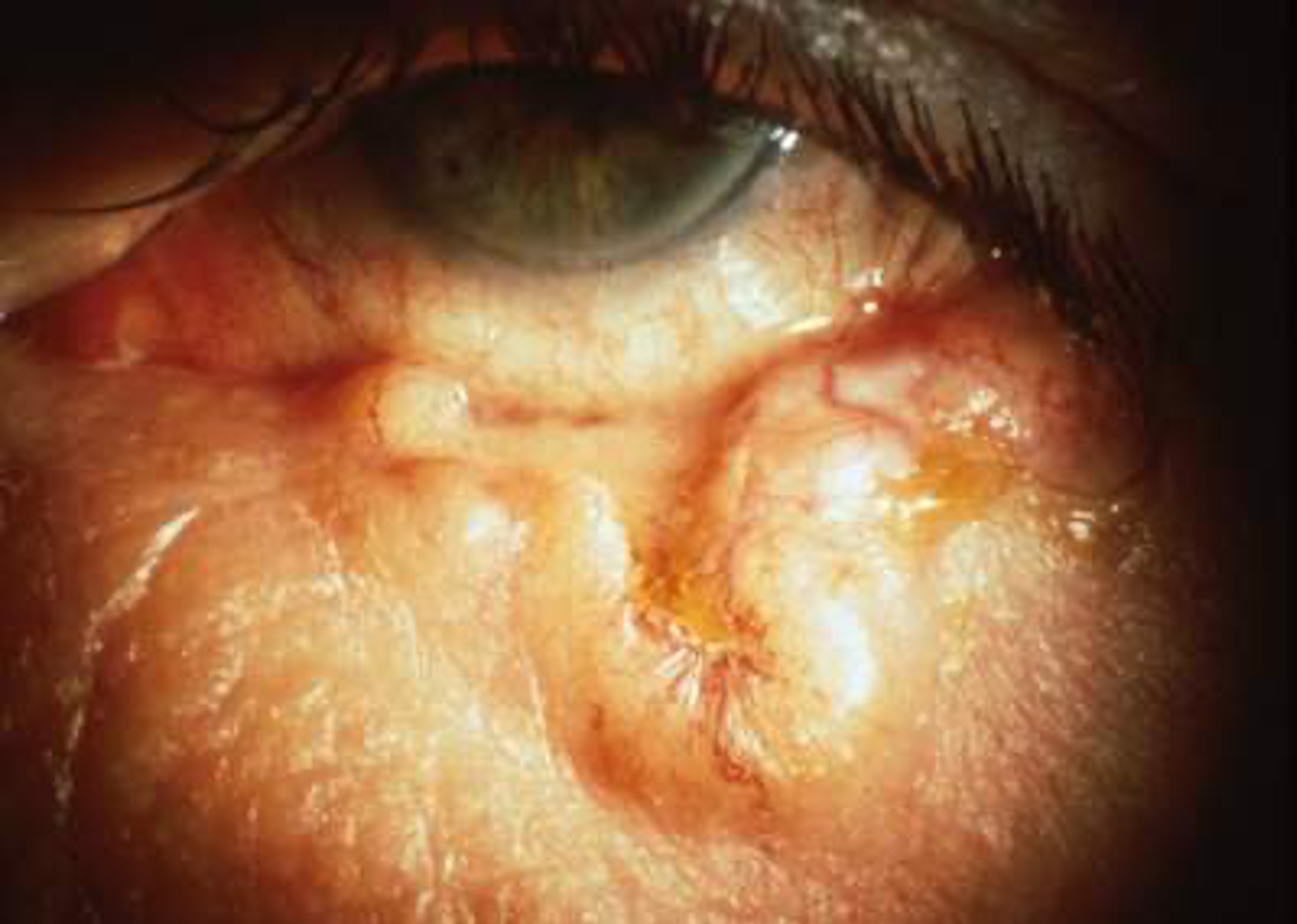 basal cell carcinoma