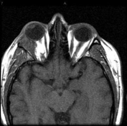 lacrimal gland adenoid cystic carcinoma