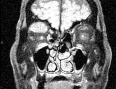 lymphoma